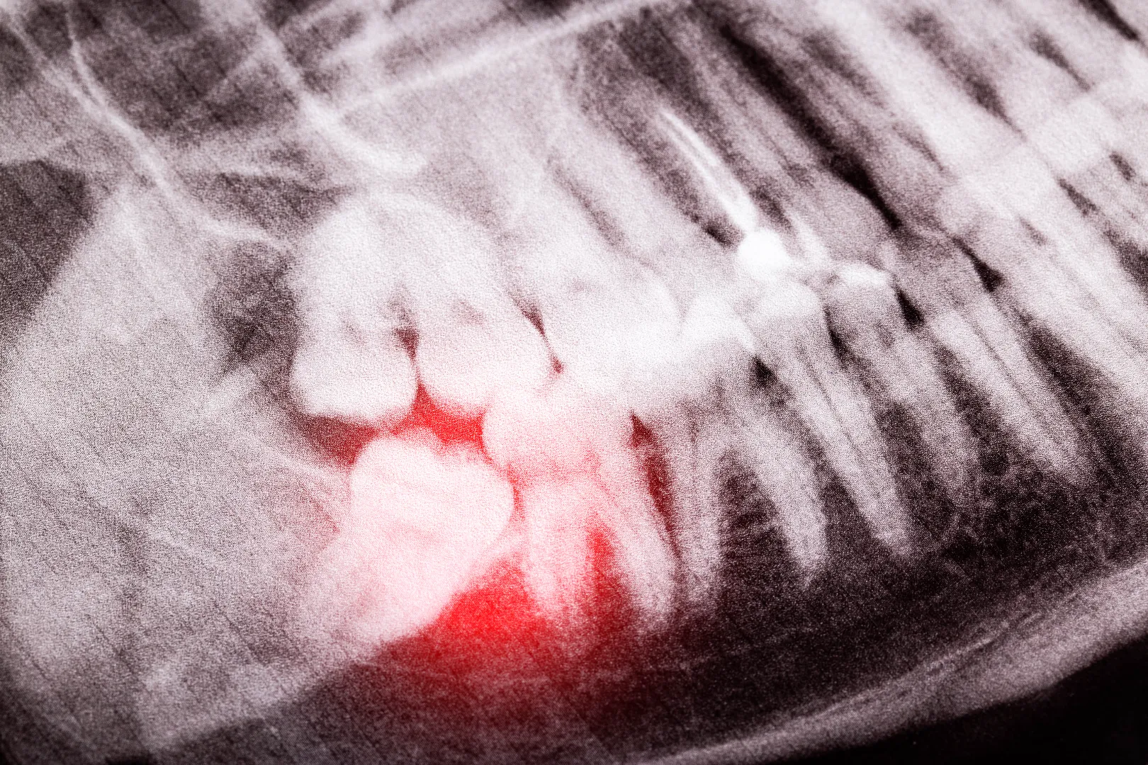 Dental X-ray showing an impacted wisdom tooth highlighted in red.